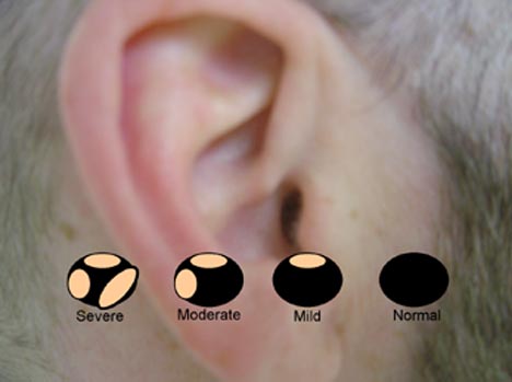 Ear Exostoses